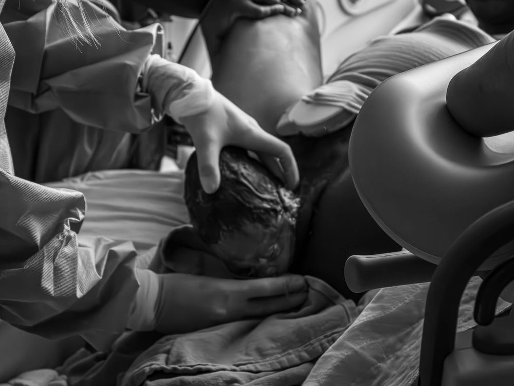 The head of a baby coming out of the mother during labor and delivery.