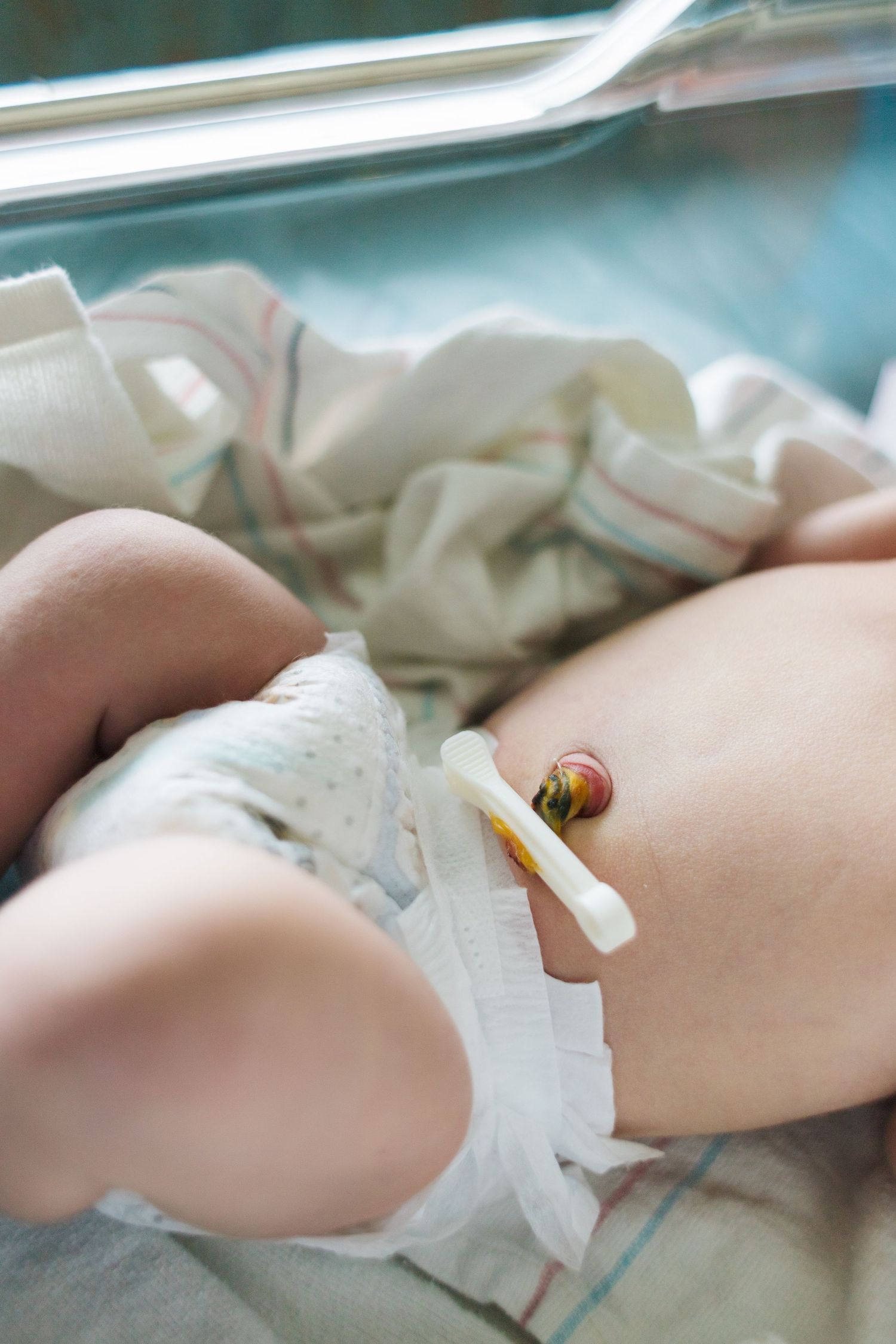 Close-up of medical equipment attached to newborn's abdomen in hospital setting.