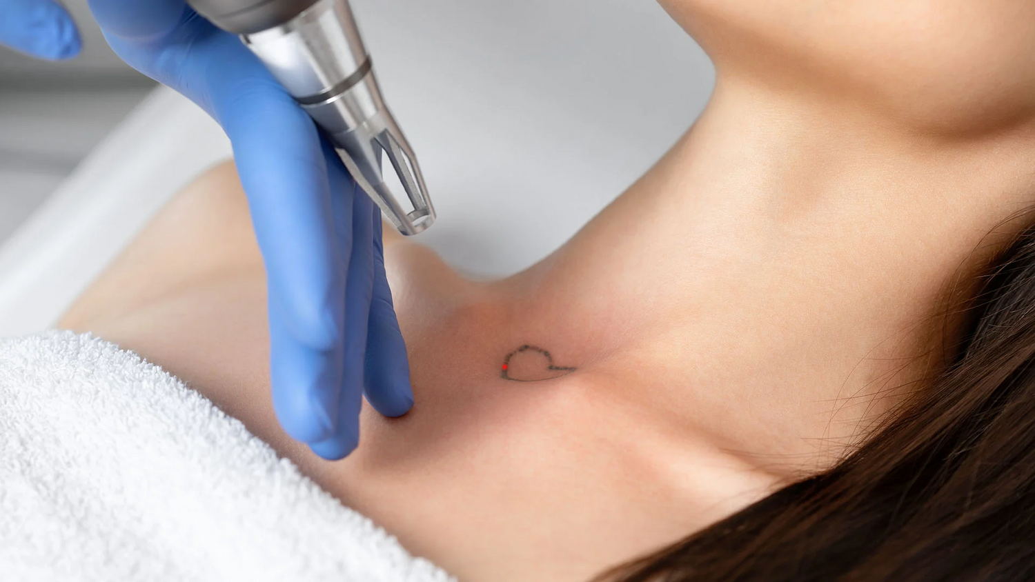 Laser Tattoo Removal in Dubai