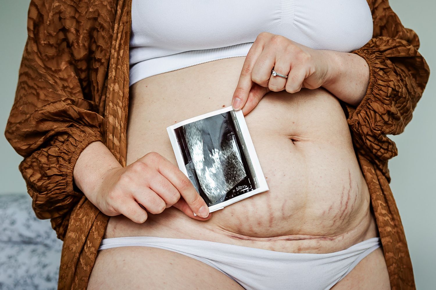 A postpartum mum holds her baby scan photo above her c-section birth scar for a caesarean awareness project by Bristol newborn photographer