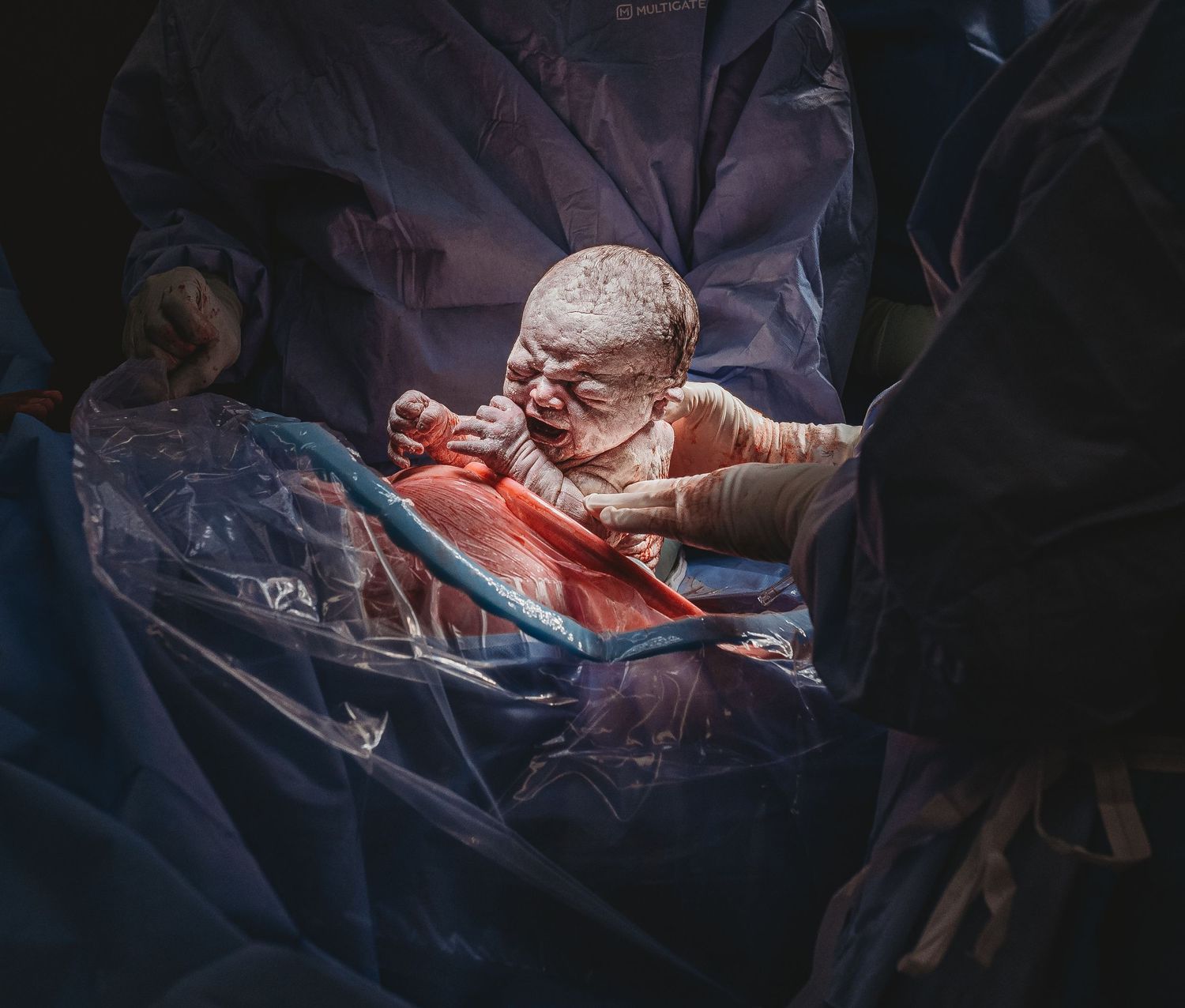 Medical team performing cesarean section surgery in dimly lit operating room.