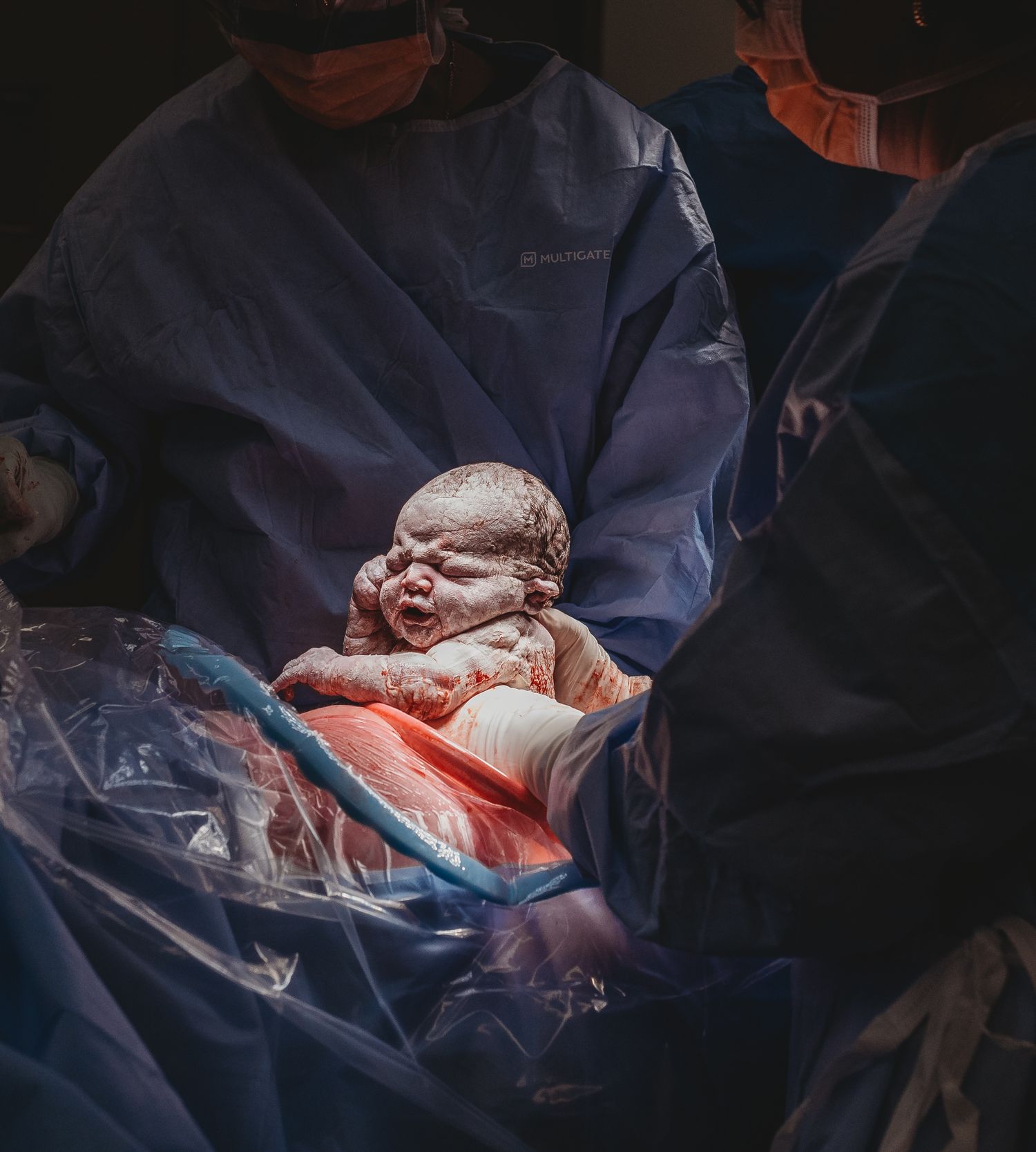 Newborn baby being delivered during cesarean section in operating room.
