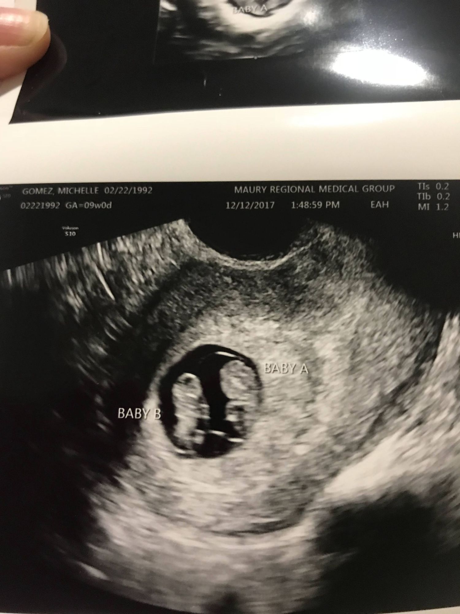 Ultrasound of an early twin pregnancy.