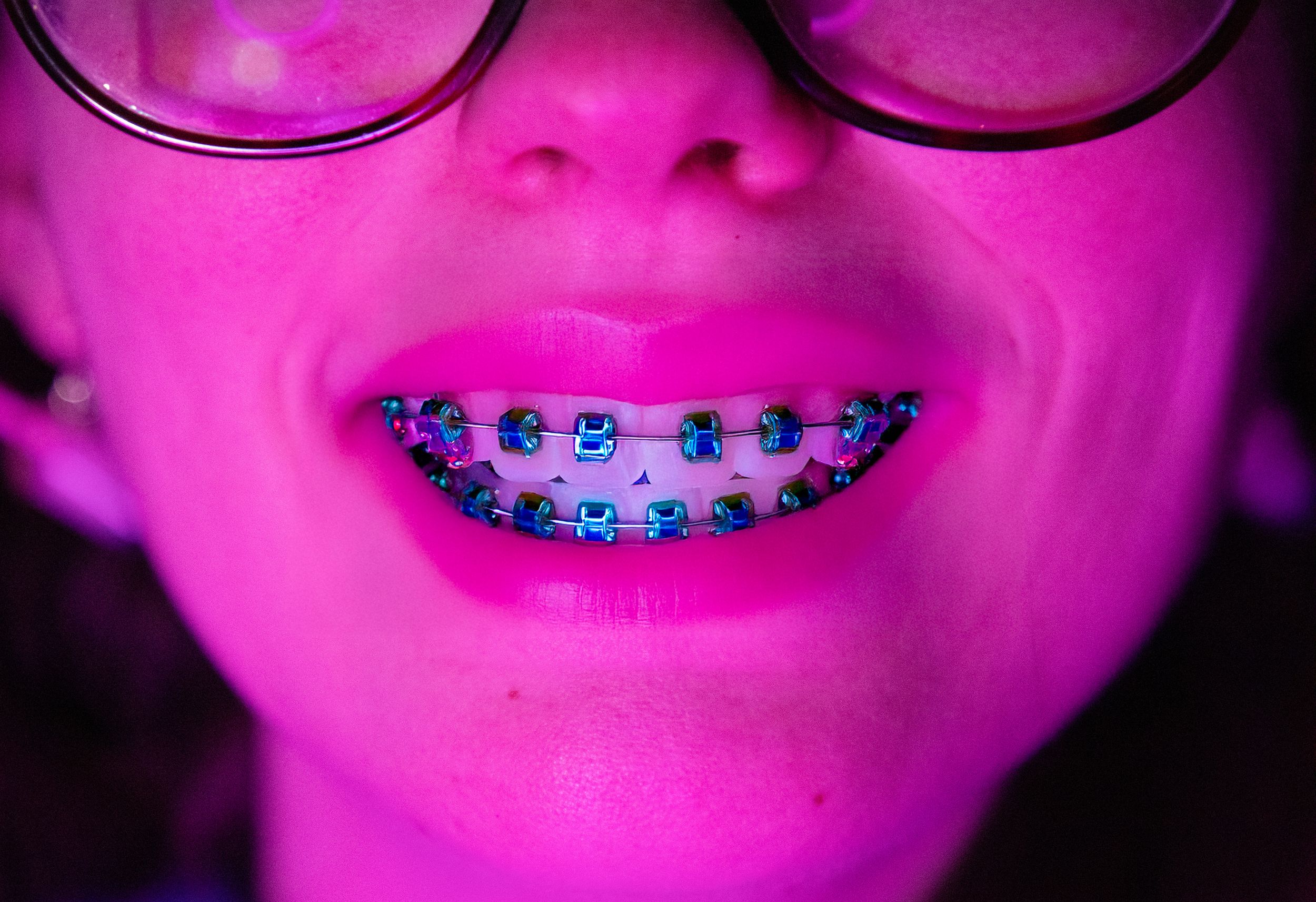braces
