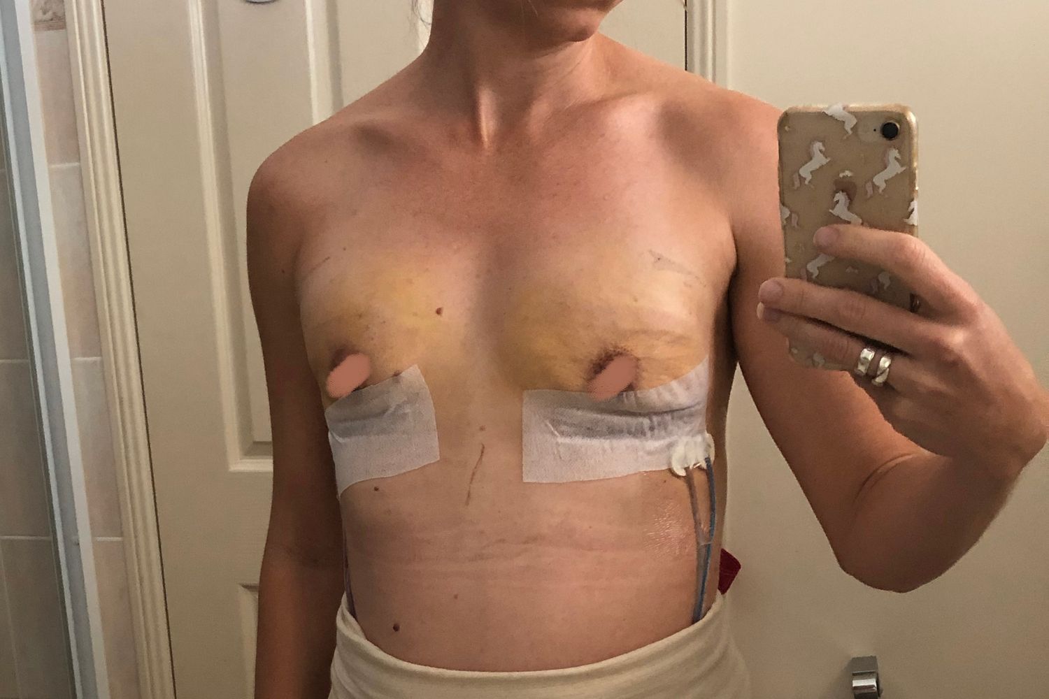 Post mastectomy with expanders and drains