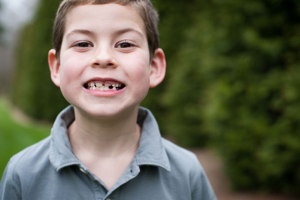 Young child smiling at camera showing missing front teeth.