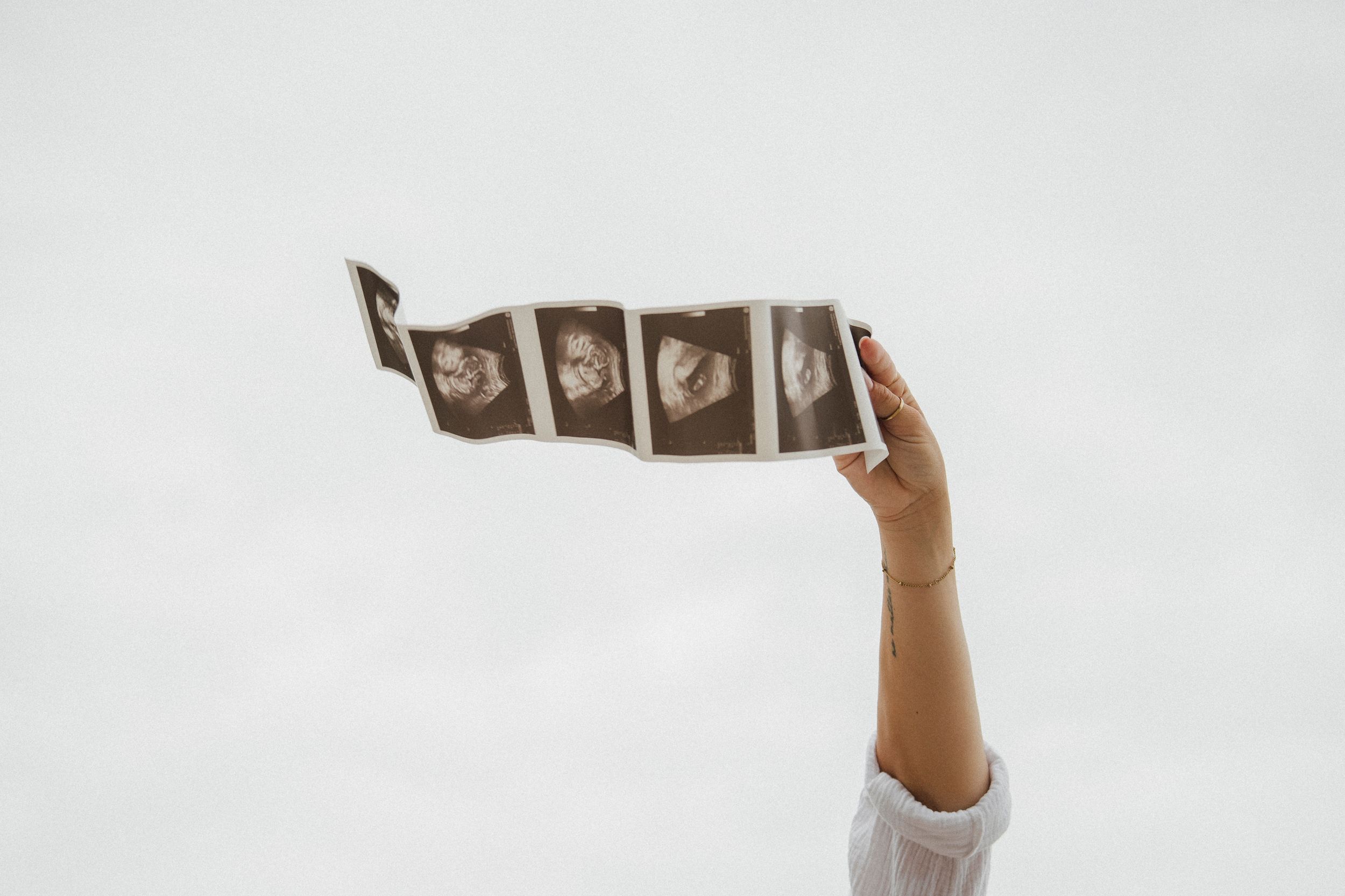 A hand holding up a strip of ultrasound sonogram images against a white background.