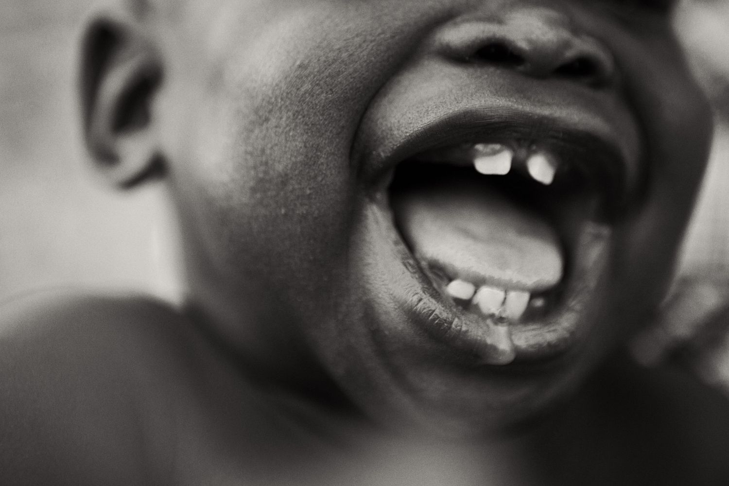 Close-up black and white portrait of a child's genuine laughter showing missing teeth.