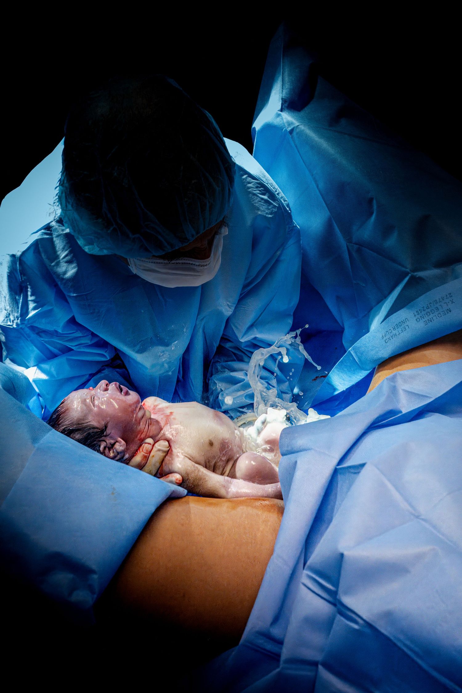 Medical team in blue scrubs performing cesarean section delivery in operating room.