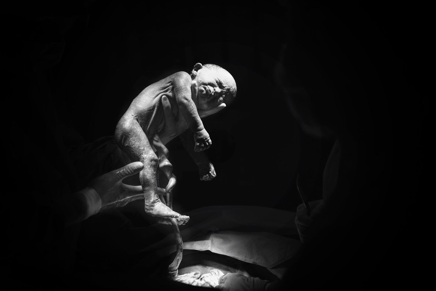 Black and white image of a newborn baby being examined under medical lights.