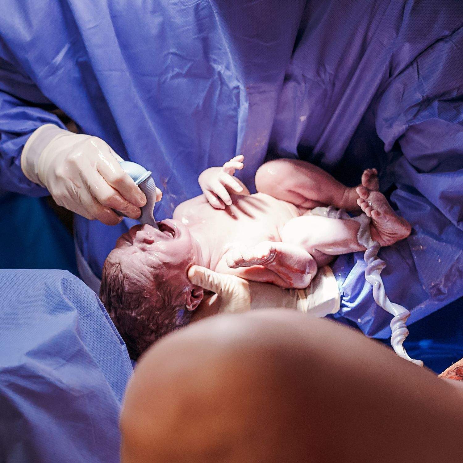 newborn baby just delivered at St.Francis hospital in Tulsa getting her airway suctioned out
