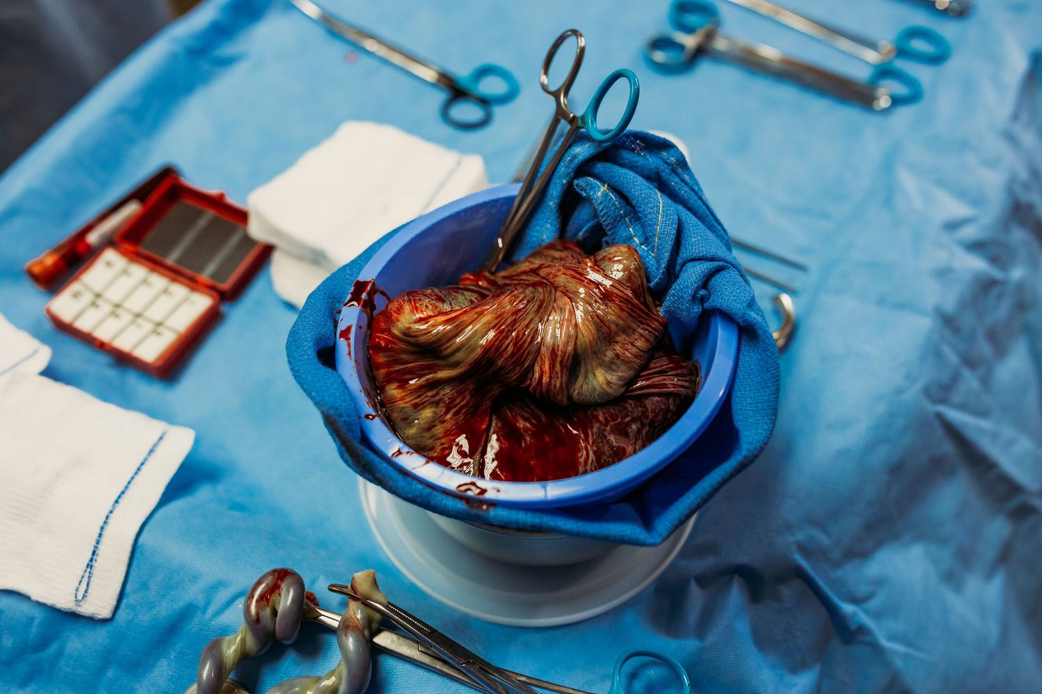 placenta and umblicord after birth in Tulsa
