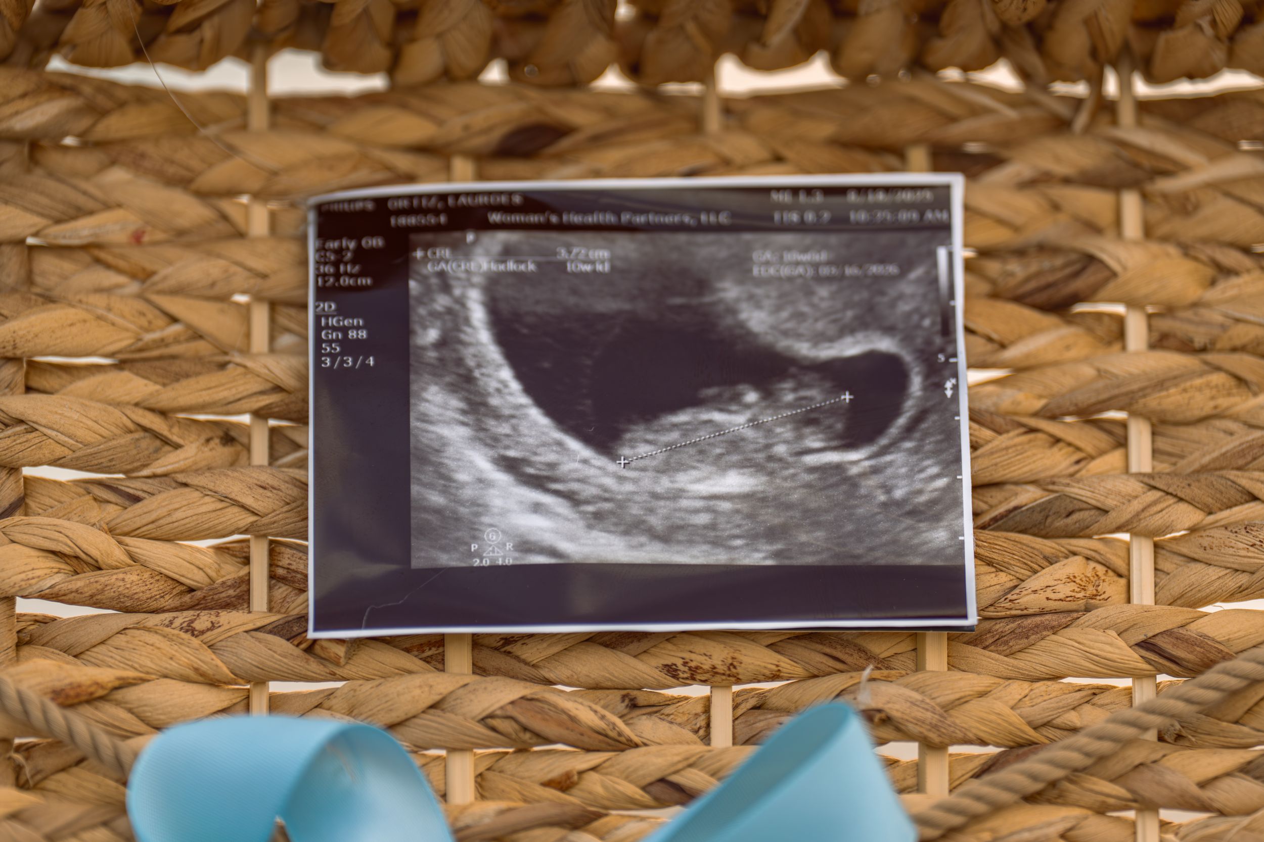 Collection of ultrasound sonogram images displayed on woven natural texture background.