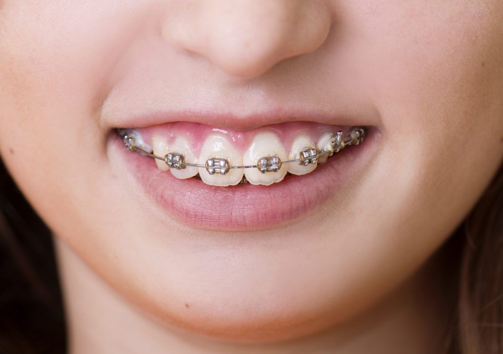 Dental Braces Cost in Dubai
