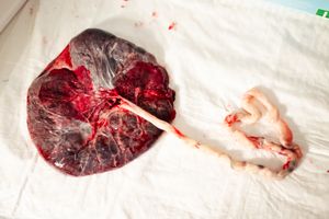 Medical examination of a placenta showing various tissue sections and blood vessels.