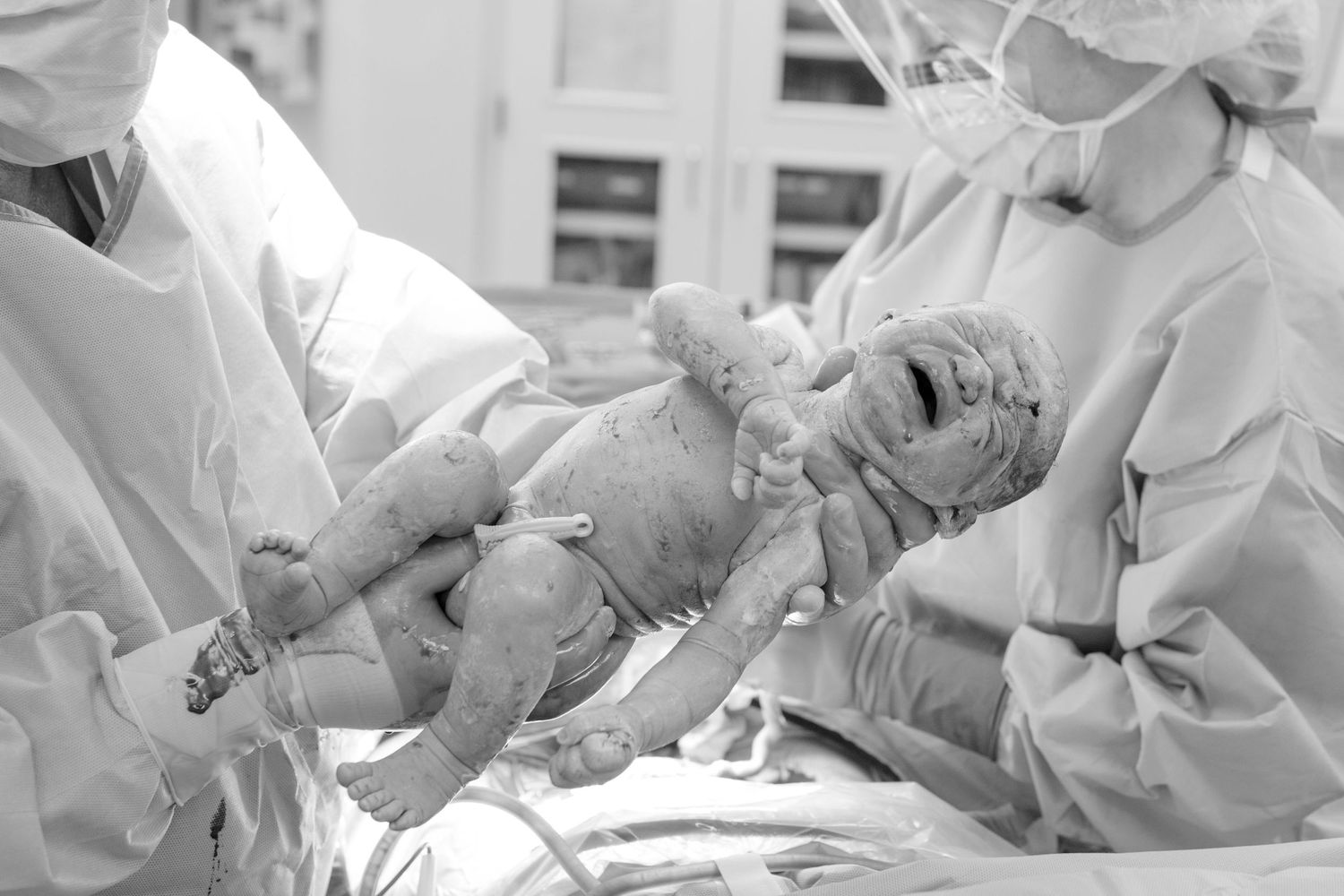 Black and white medical image showing newborn delivery in hospital operating room.