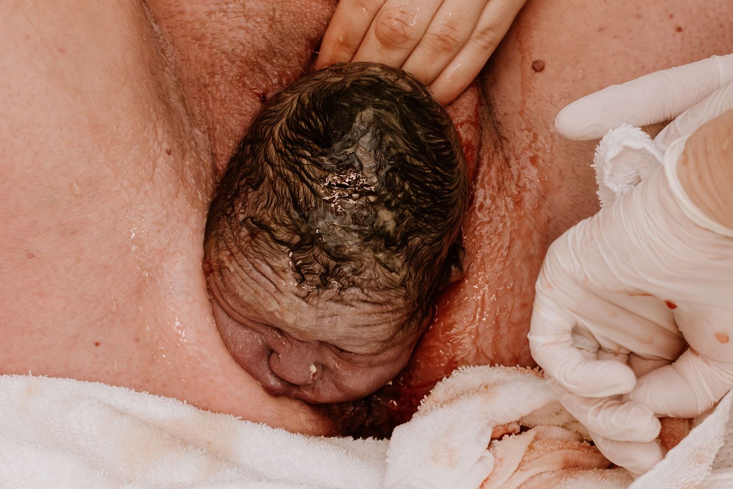 Newborn baby emerging during natural childbirth process.