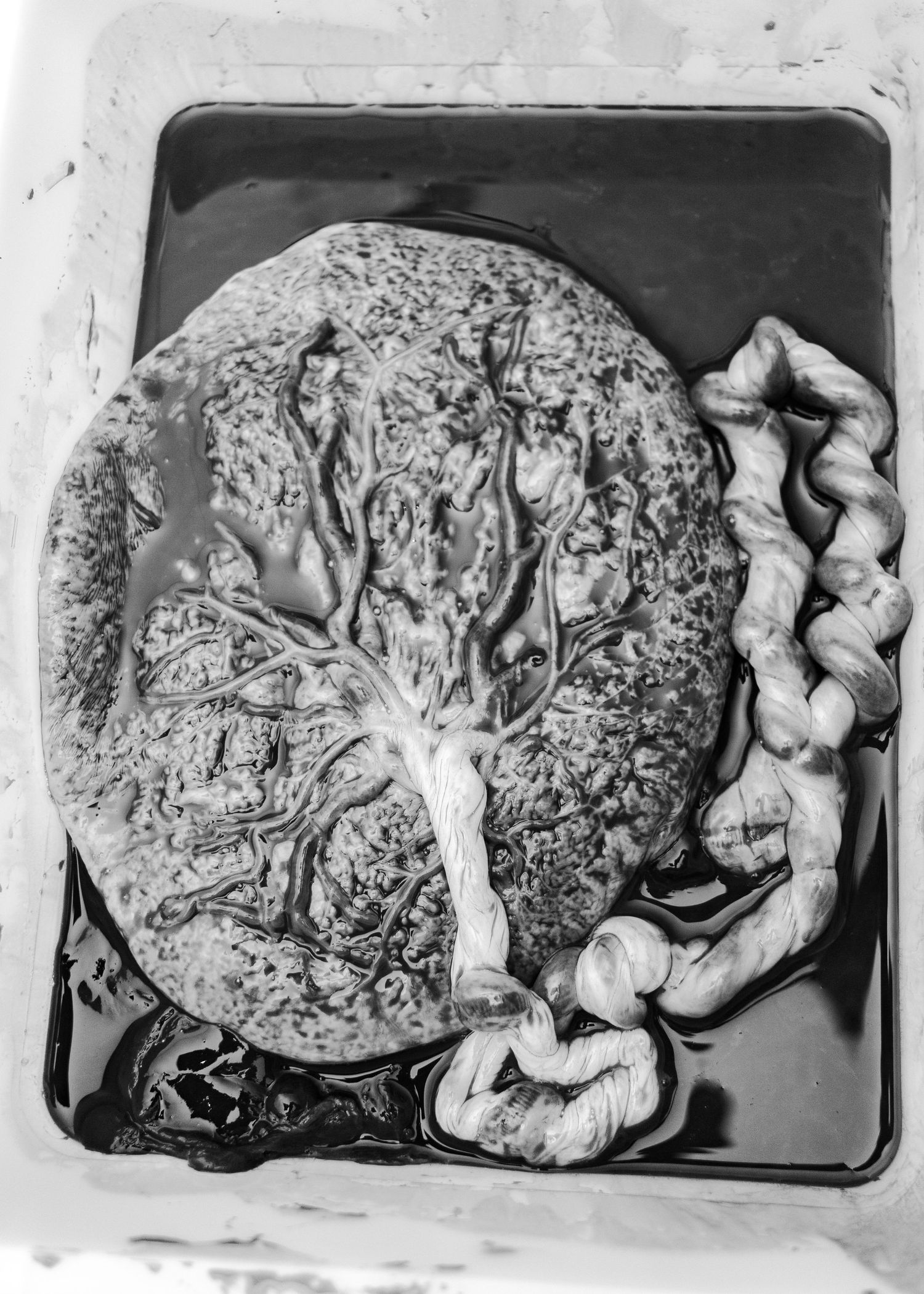Black and white medical photograph showing placenta and umbilical cord post-delivery.