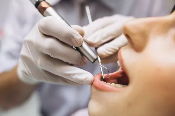 Tooth Filling Cost in Dubai