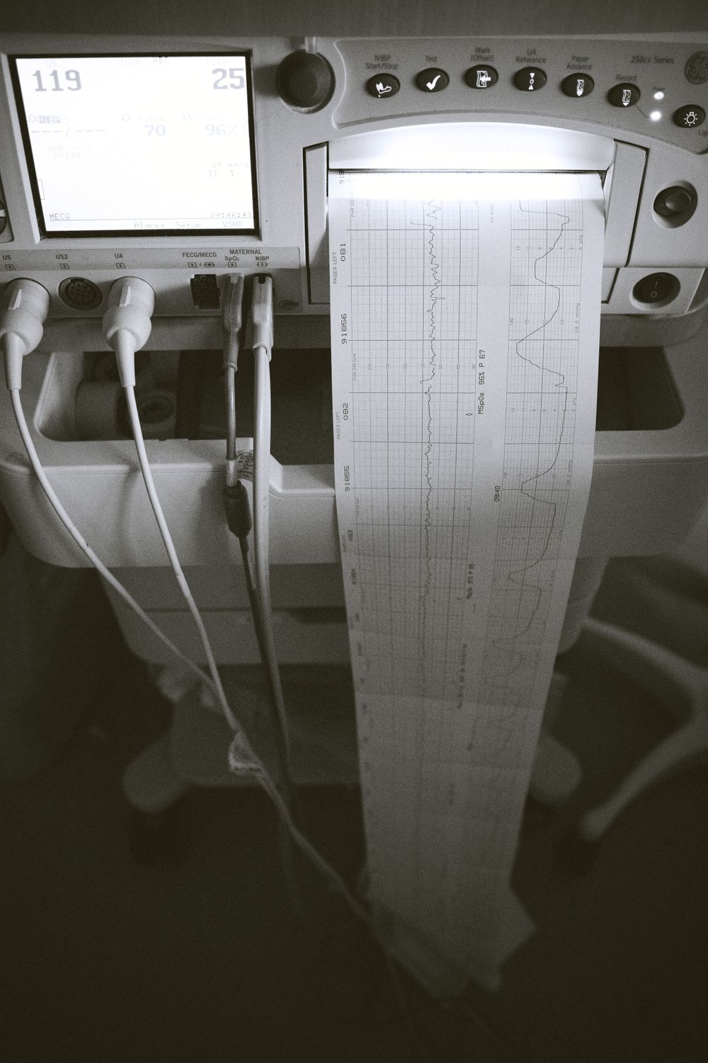 Medical monitoring equipment displaying vital signs and data charts.