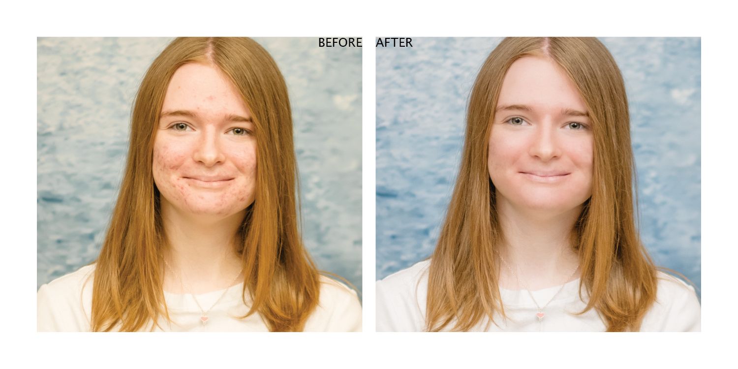 Side by side before and after photo comparison showing subtle beauty enhancement effects.