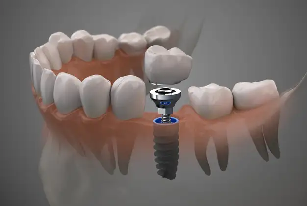 Single Tooth Implant Cost in Dubai
