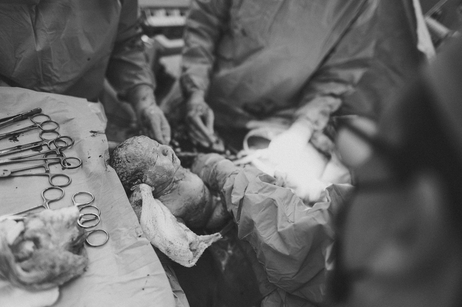 Black and white image of surgical procedure with medical instruments on table.