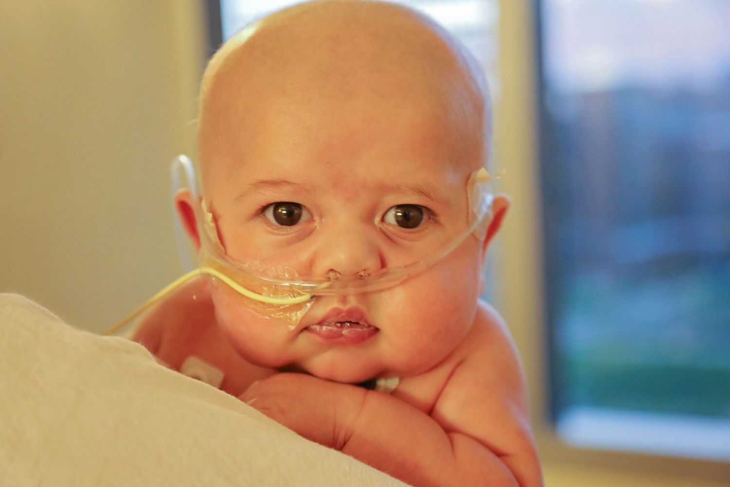 baby dilbert looking over mothers shoulder before open heart surgery
