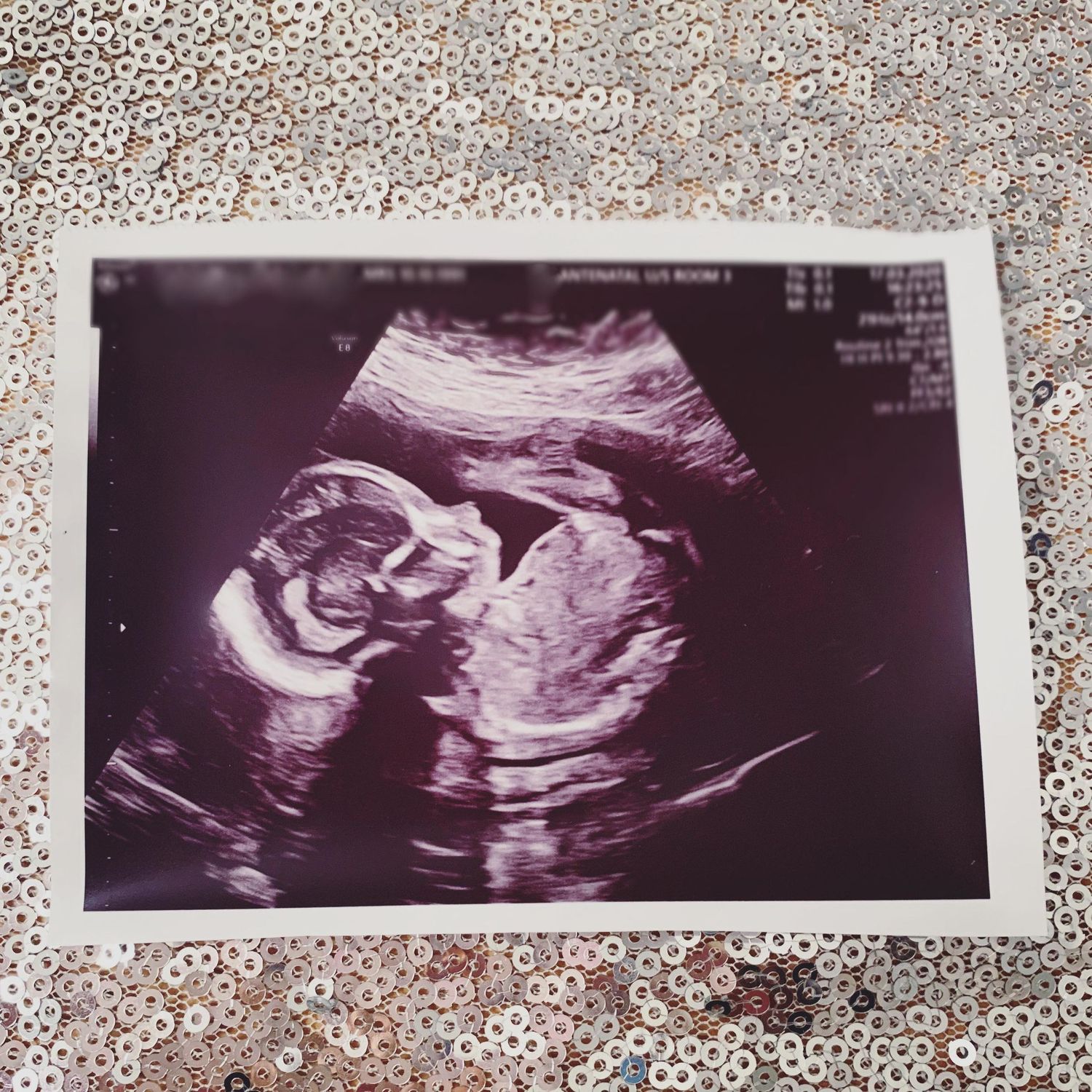 Black and white ultrasound scan showing detailed fetal development in the womb.