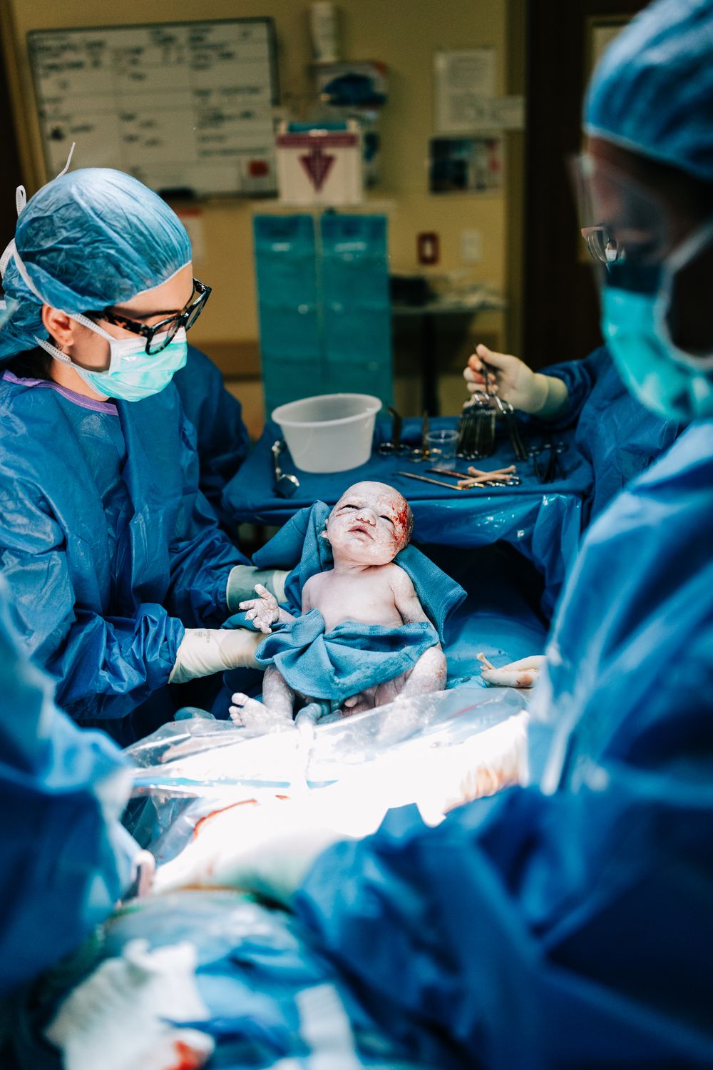 Newborn being delivered via cesarean with it's eyes open, Santa Maria, CA