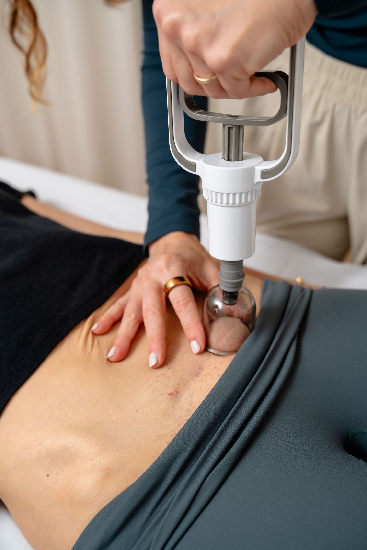 Therapist performing vacuum cupping massage therapy on a patient's abdomen using a professional medical device.