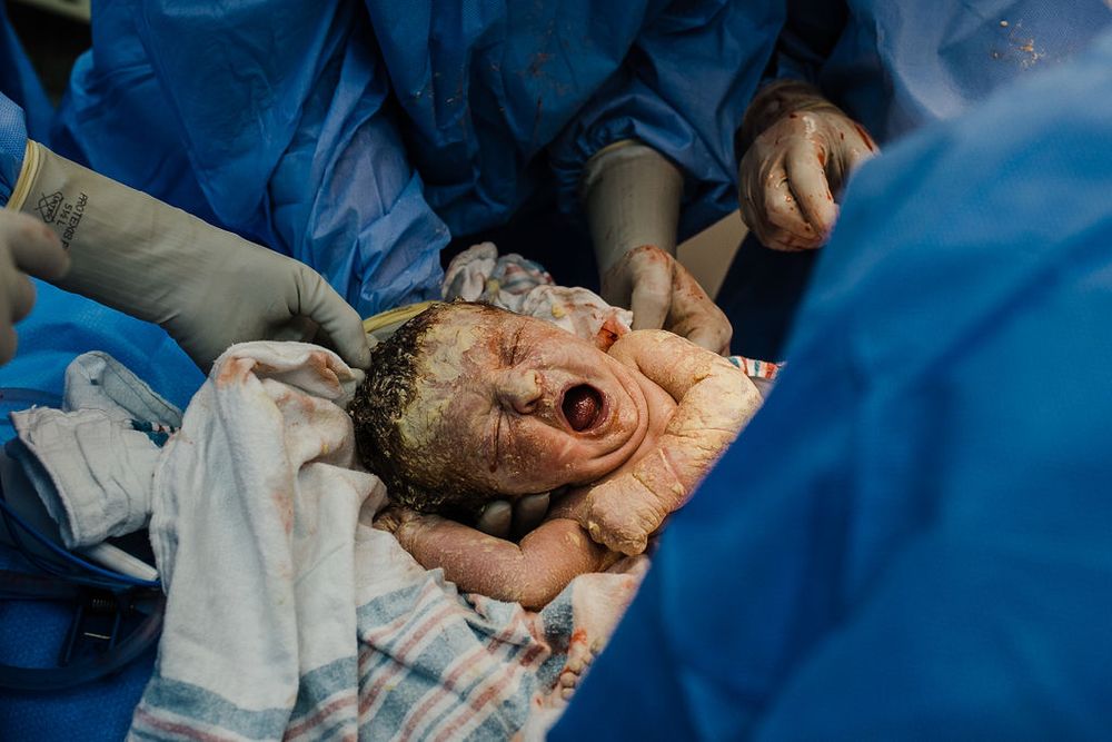 A newborn's first cry captured in a medical setting.