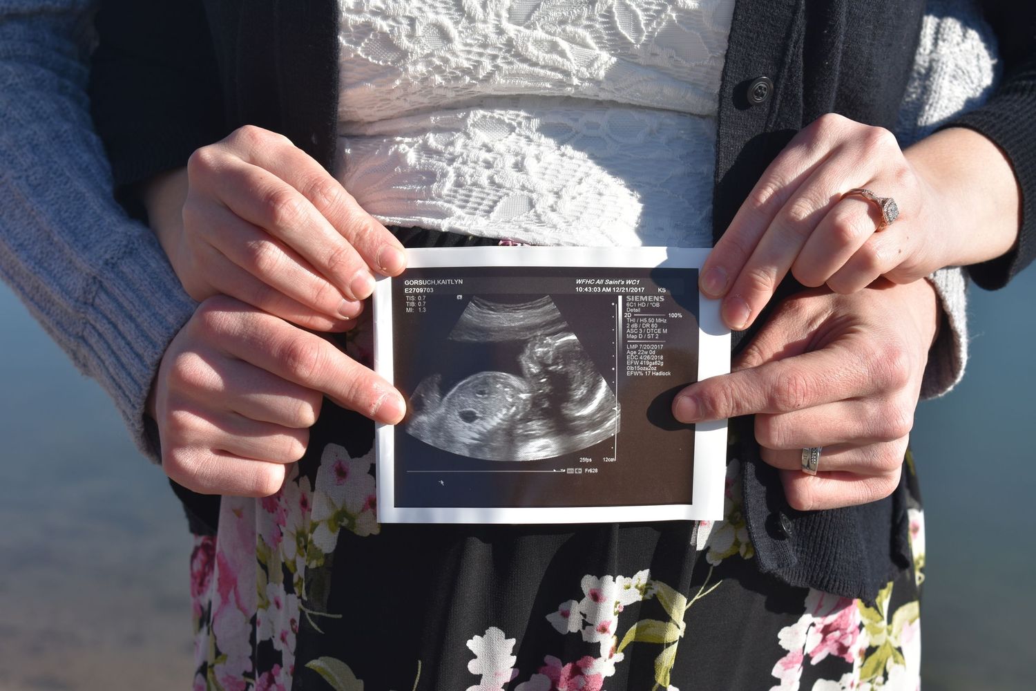 Hands holding up an ultrasound photo against a lace dress background.