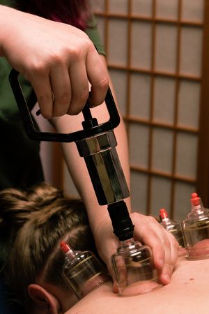 Close-up of hands applying glass cupping therapy tools on patient's back.