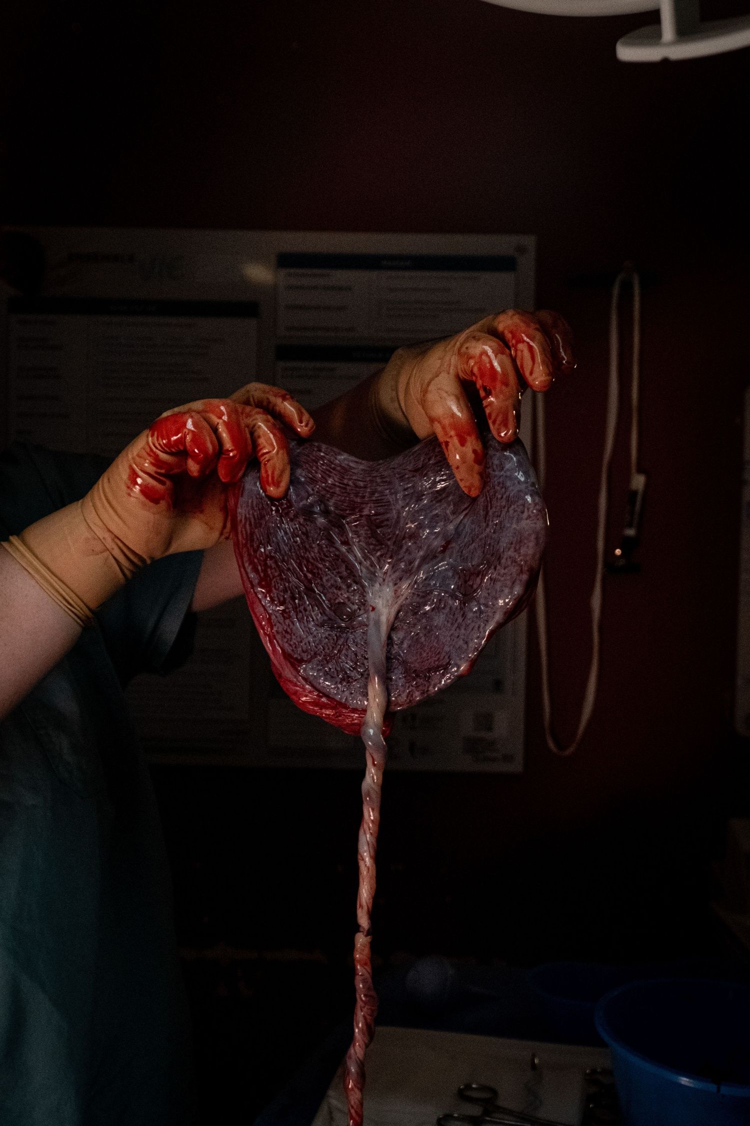 Medical professional holding a freshly delivered placenta with umbilical cord in delivery room.