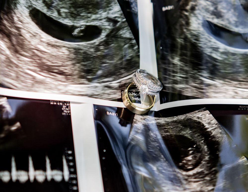 Wedding rings resting on ultrasound sonogram images, symbolizing pregnancy announcement and new family milestone. Pregnancy Announcement.