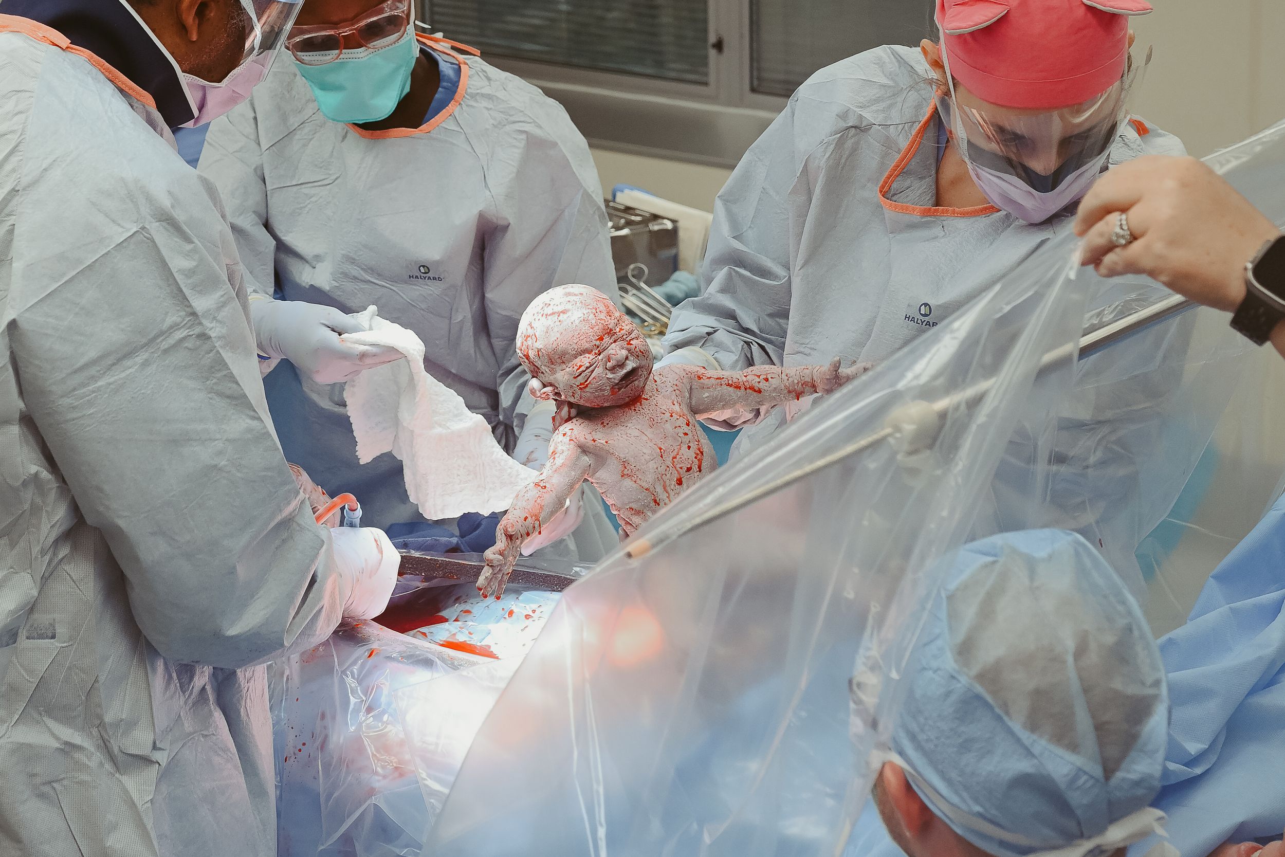 Birth photographer captures baby girl being born in the operating room via cesarean section at St. Thomas in Nashville, Tennessee.