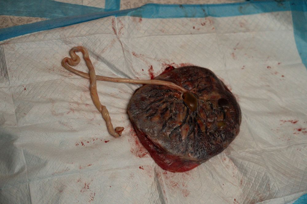 Placenta shaped in a heart, symbolizing the deep connection and love between mother and child, captured after a beautiful home birth