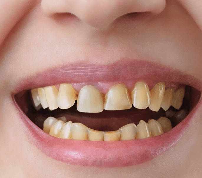 Vitamin Deficiency Causes Yellow Teeth in Dubai