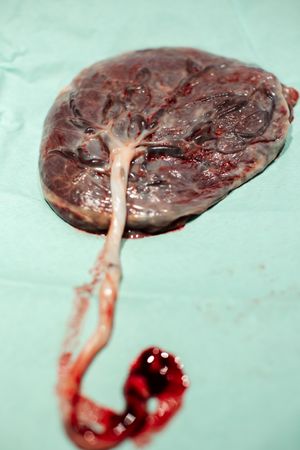 Medical image showing a placenta specimen with blood vessels against a teal background.
