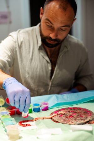 Healthcare provider examining placenta on medical tray with gloved hands.
