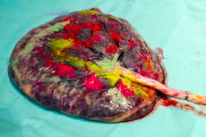 Colorful dye or paint being injected into placental tissue on teal background.