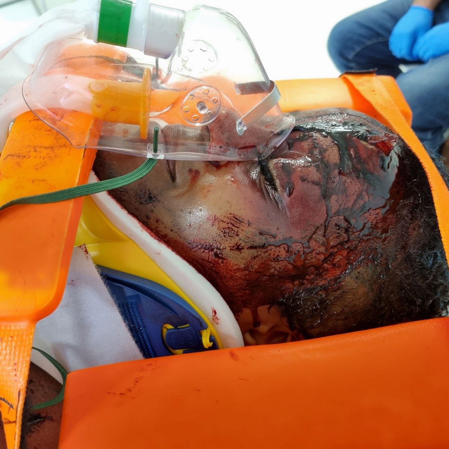 an RTA victim for an ATLS course