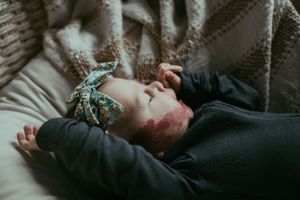 Sleeping newborn baby with a port-wine stain birthmark wearing a floral headband on a soft blanket.