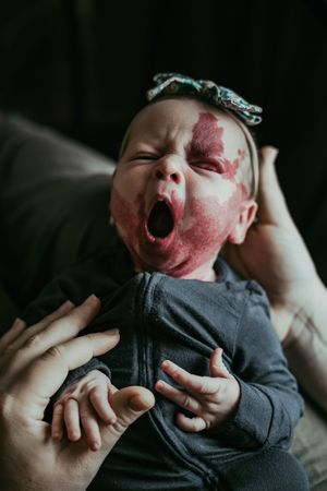 Yawning newborn baby with port-wine stain birthmark wearing a floral headband being held by parent.