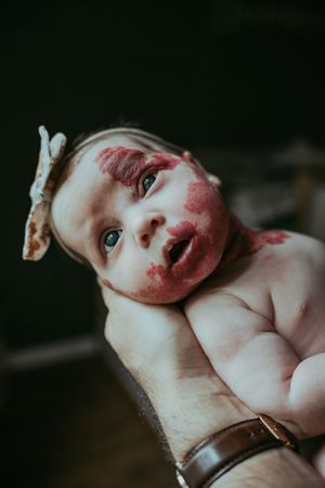 Newborn baby with port-wine stain birthmark on face being cradled in adult hands.