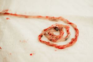 Close-up of a coiled umbilical cord with blood on a white surface after birth.