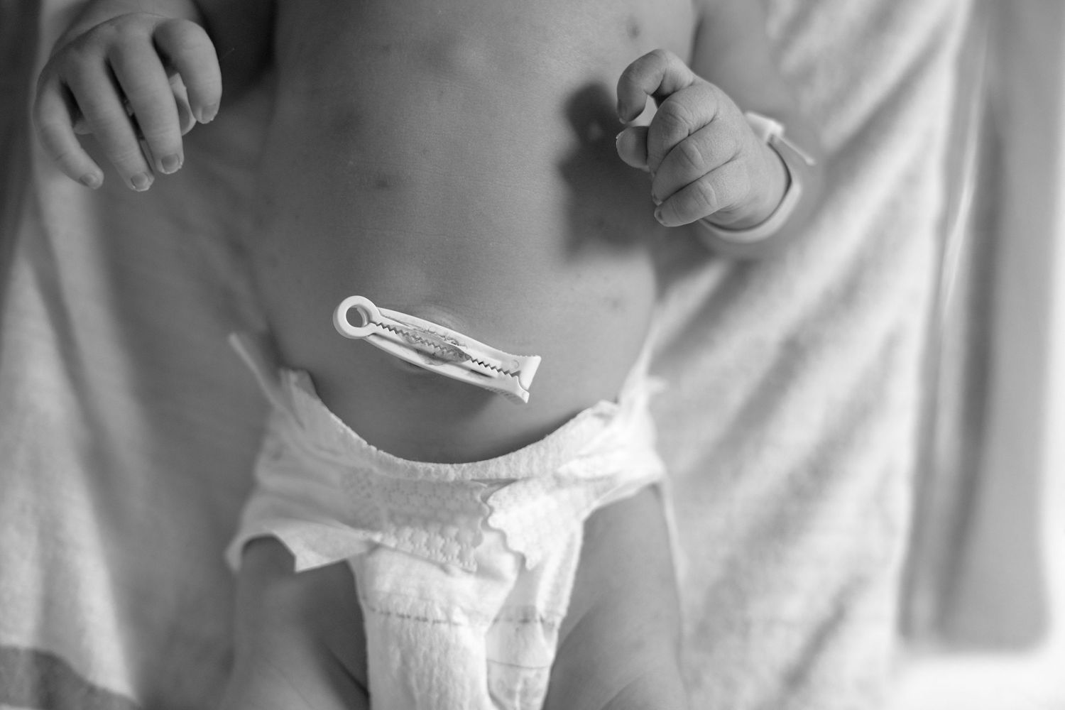 Black and white photo of a newborn baby in a diaper with a medical clip on the umbilical cord stump.
