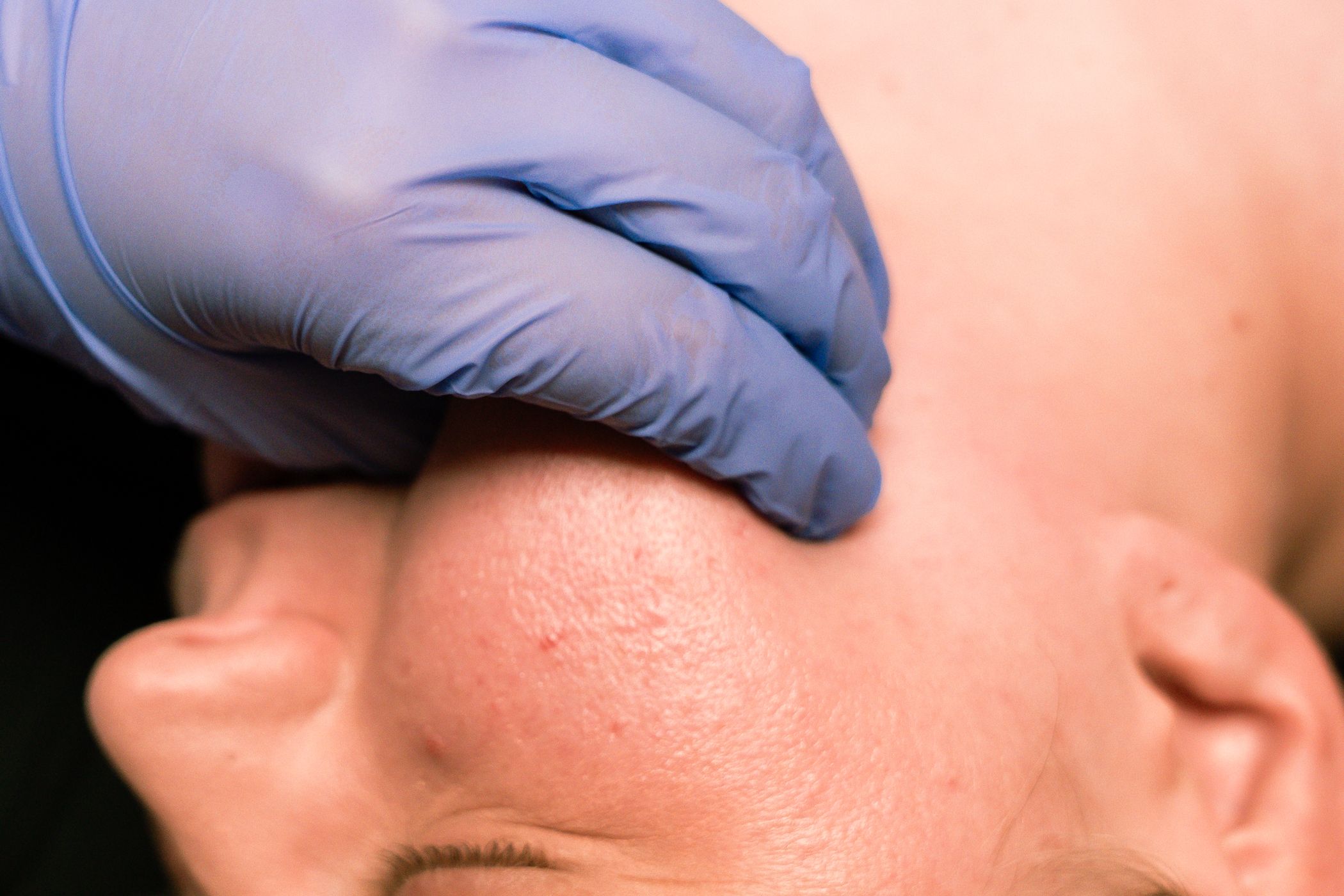 Medical professional wearing blue gloves examines patient's nose during a cosmetic procedure.