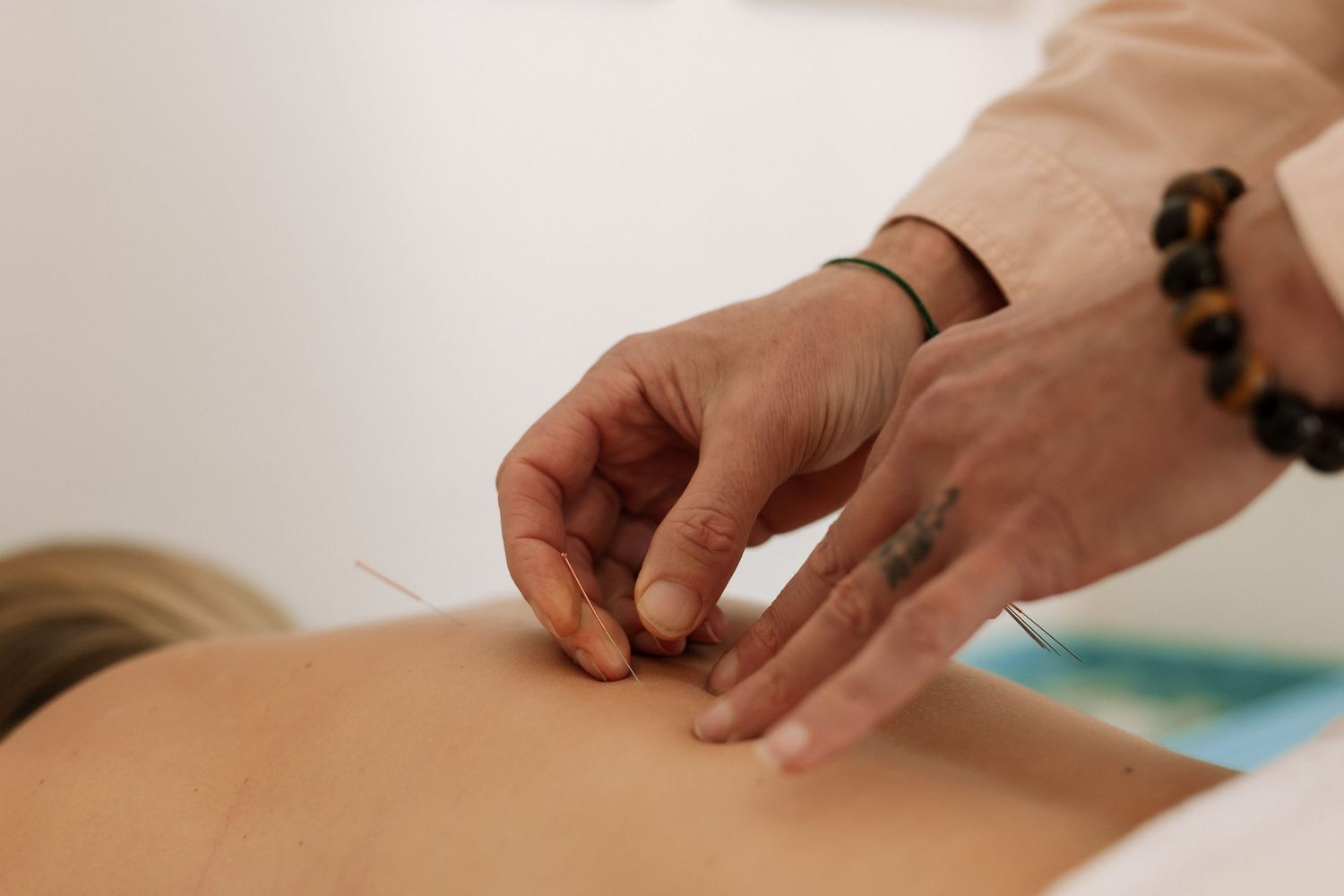 Acupuncturist inserting thin needles into a patient's back during a traditional acupuncture therapy session.